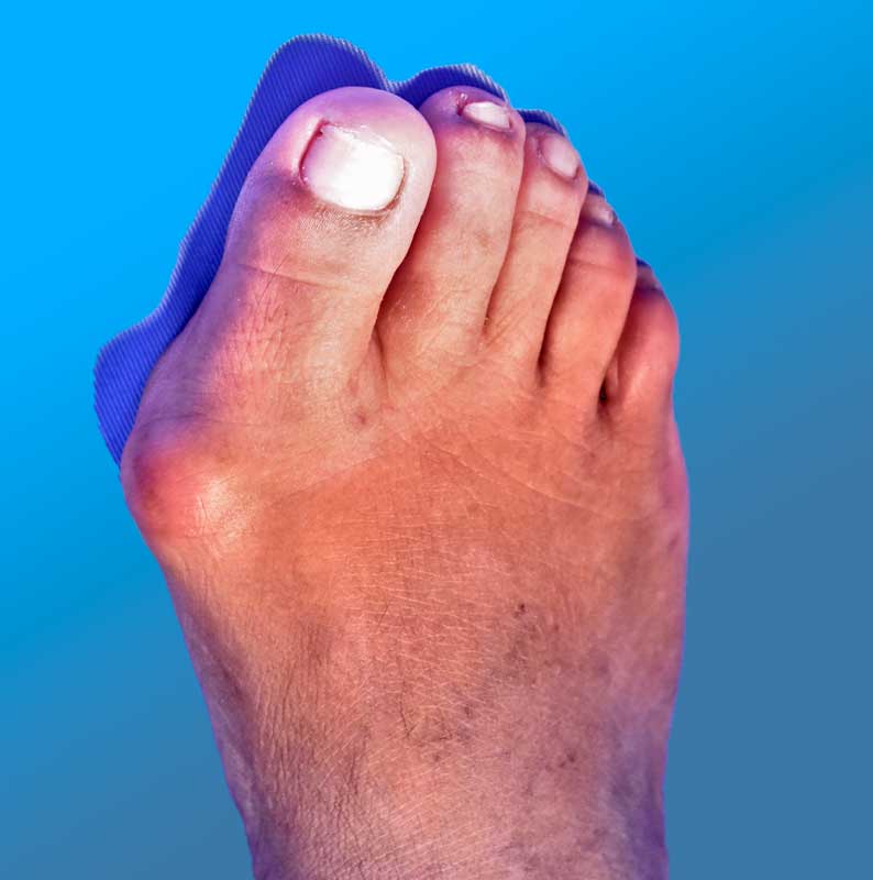 Hallux Valgus o Juanete se trata con ortopedistas especialistas en cirugía de Pie y Tobillo.