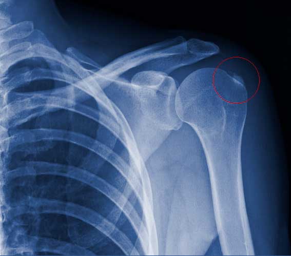 calsificación del Hombro. Hombro doloroso Ortovital Barranquilla